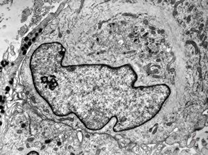F, 49y. | myelosarcoma … histiocyte-like cells in dermal infiltrates